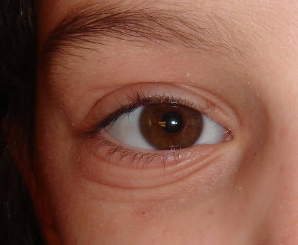 אטופיק דרמטיטיס - בצקת באזור העיניים
