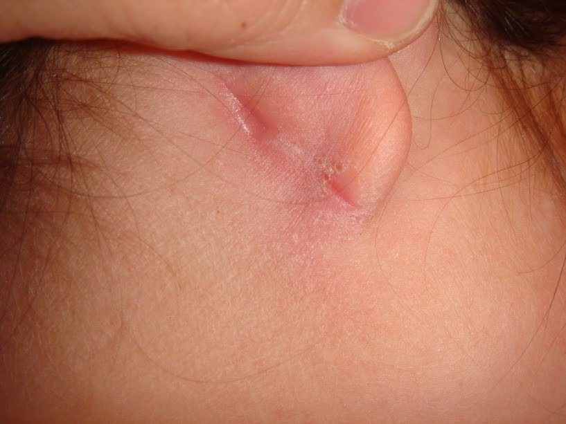 אטופיק דרמטיטיס - סדקים באזור האוזן