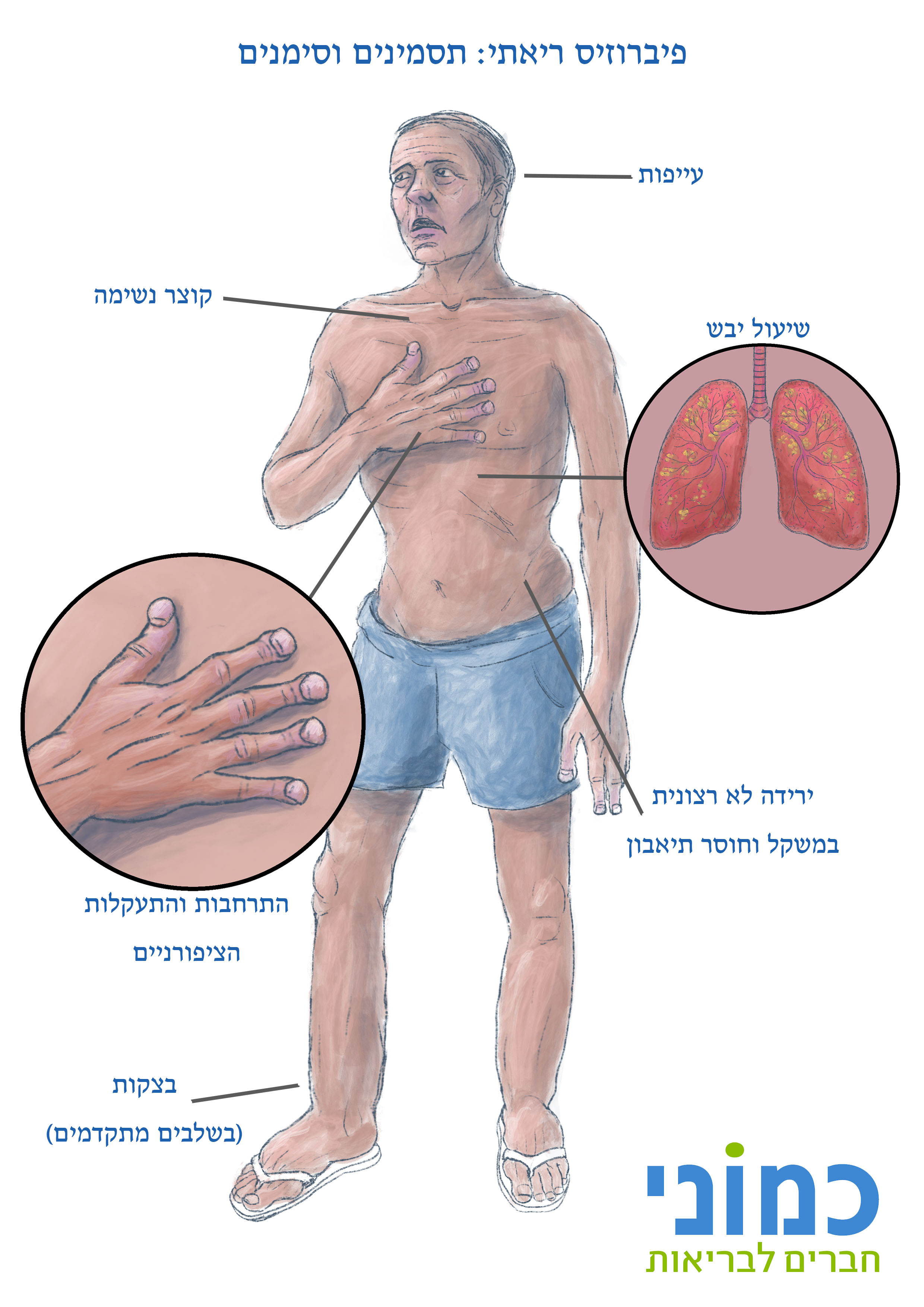 פיברוזיס ריאתי - תסמינים וסימנים