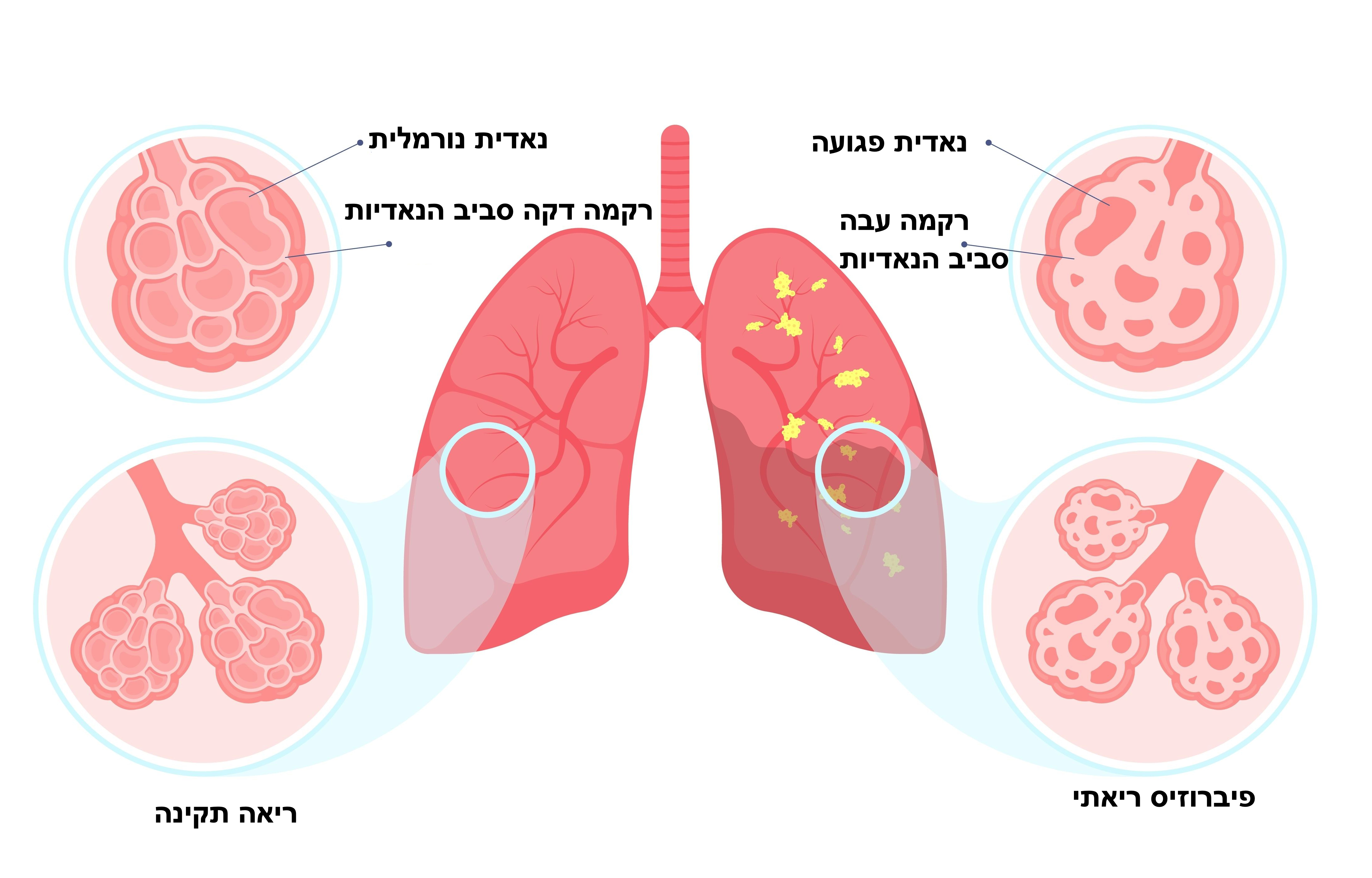 התהליך של פיברוזיס ריאתי