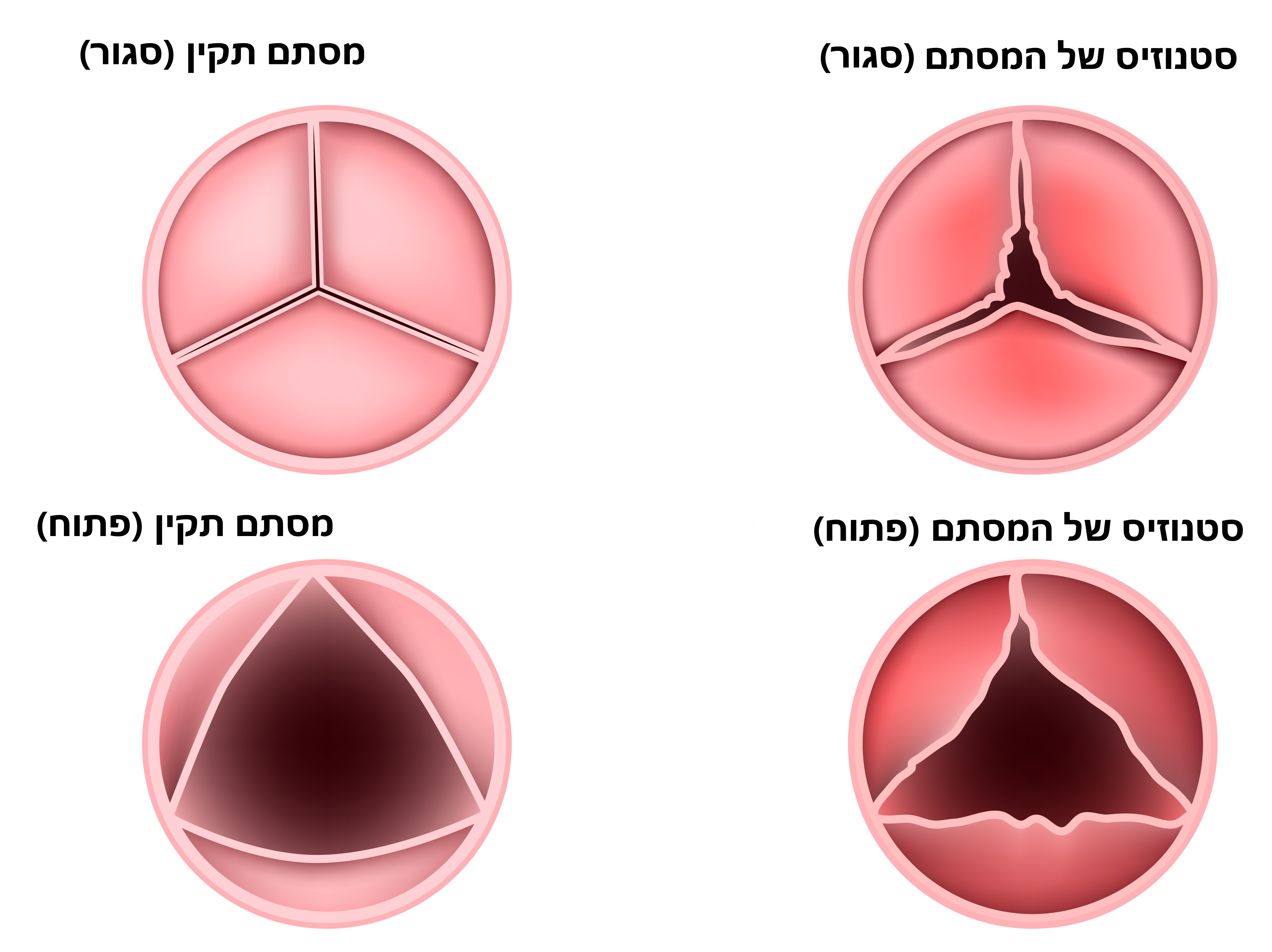 בעיות במסתמי הלב