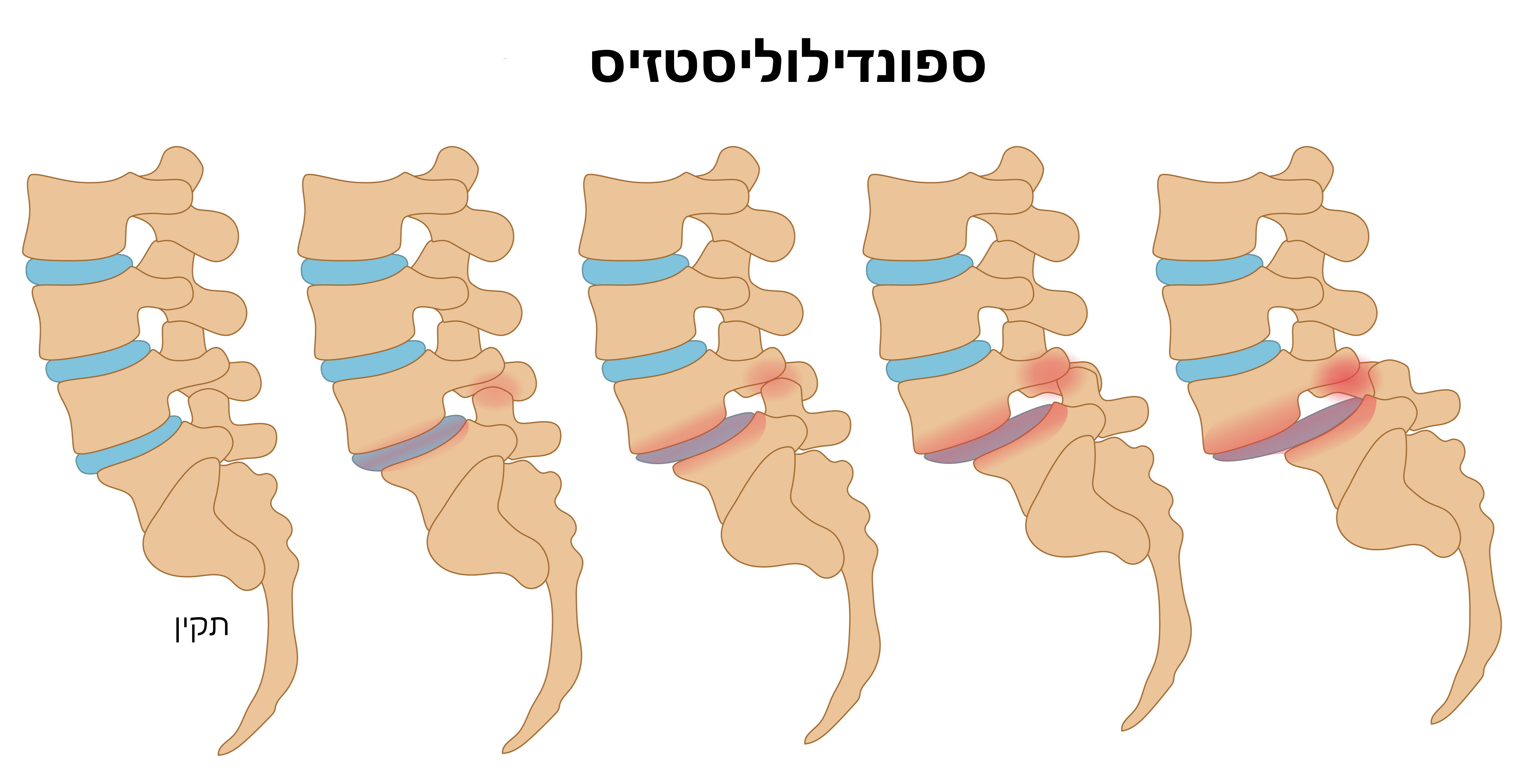 ספונדילוליסטזיס