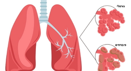 פיברוזיס ריאתי: כל מה שצריך לדעת