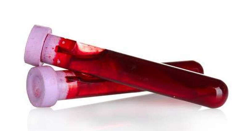 בדיקת דם לאיתור הנוגדנים אולי תסייע באבחון טרשת נפוצה (צילום: Shutterstock)