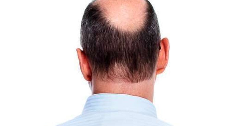 נסיגת קו שיער באזור הרקות והתקרחות במרכז הראש עשויים לנבא סיכון מוגבר למחלת לב (צילום: Shutterstock)