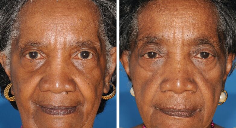 התאומה משמאל לא מעשנת. התאומה מימין עישנה במשך 29 שנים, כפי שניתן לראות בהזדקנות מסביב לעיניים (תמונות: Plastic and Reconstructive Surgery/American Society of Plastic Surgeons) 