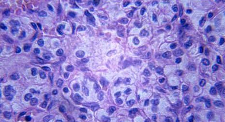 בחולי סוכרת סרטן הלבלב היה שכיח פי שש וסרטן תאי הכבד- פי 4 (צילום: אתר סטוק פוטוז) 