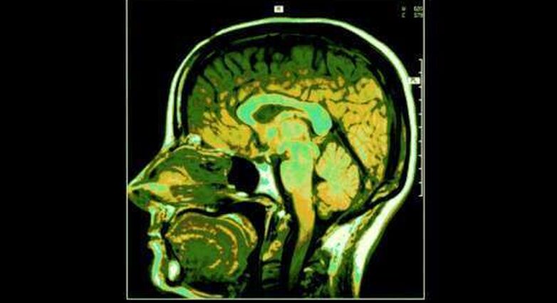 כשהנשים טופלו וחזרו למשקל תקין, תוך שבועות ספורים נפח המוח התחיל לחזור למימדים נורמאליים (צילום: אתר סטוק פוטוז)