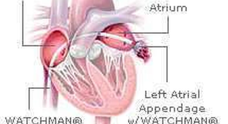 מיקום ההתקן בלב (באדיבות המרכז הרפואי שיבא)