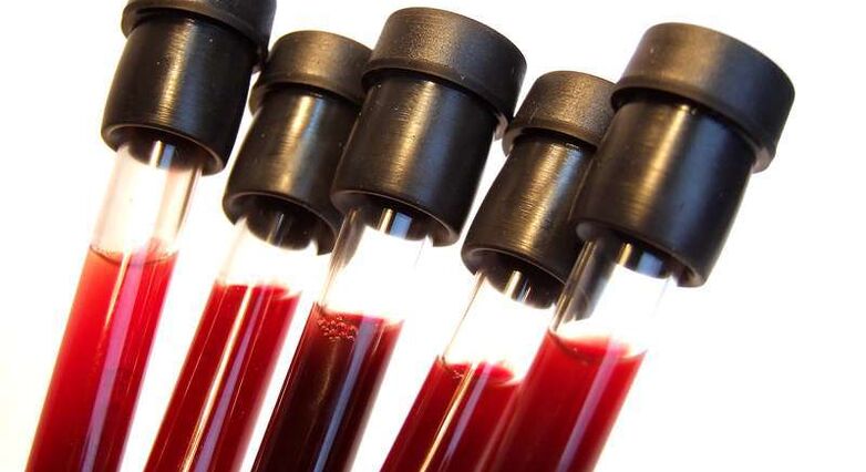 רמות הטריגליצרידים בדם קשורות לסיכון לשבץ איסכמי (צילום: panthermedia)
