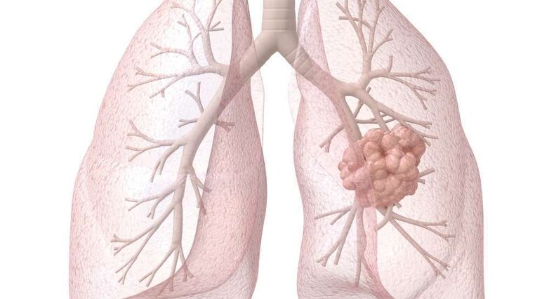 לחולי סרטן הריאות סיכון גבוה ב- 50% לשבץ בתקופה שלאחר האבחון (צילום: Shutterstock)