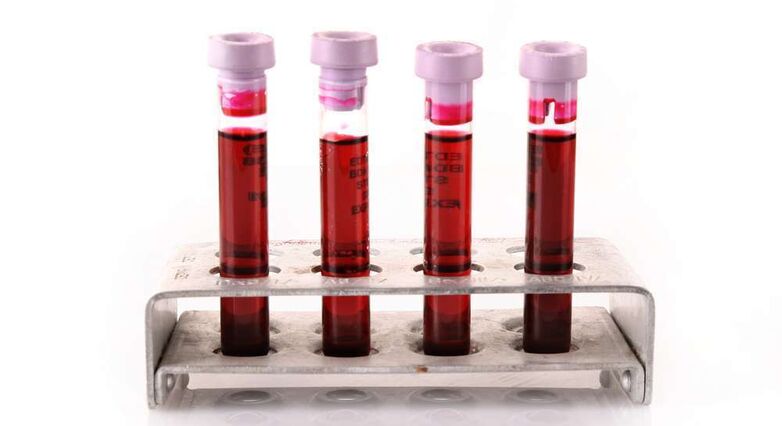 סוג דם AB, הסוג הנדיר ביותר, נקשר לסיכון מוגבר לשבץ (צילום: Shutterstock)