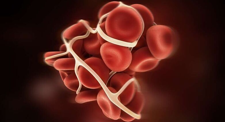 יתכן כי חוסר ברזל גורם לעליה בגורם קרישה מספר 8 וכתוצאה מעודד היווצרות קריש דם (צילום: Shutterstock)