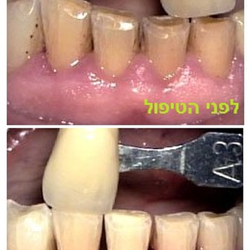 טיפול שיניים בלייזר - הכל על הלבנת השיניים