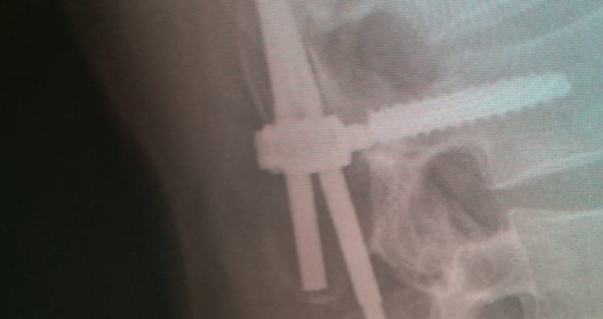 שבר בבורג לאחר ניתוח קיבוע