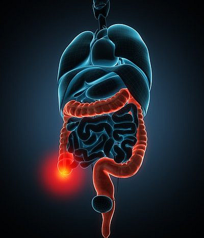 סרטן המעי הגס (צילום: Shutterstock)