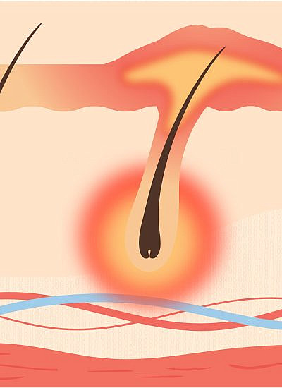 הידרדניטיס סופורטיבה Hidradenitis Suppurativa (איור: ירדן אדר)