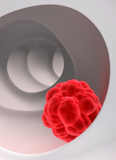סרטן המעי הגס - מיקום הגידול (צילום: shutterstock)